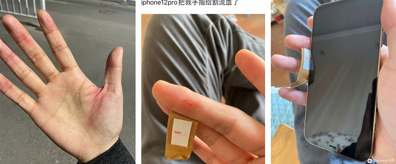 Пользователи iPhone 12 проливают кровь. Для некоторых корпус смартфона оказался слишком острым Пользователи iPhone 12 проливают кровь. Для некоторых корпус смартфона оказался слишком острым